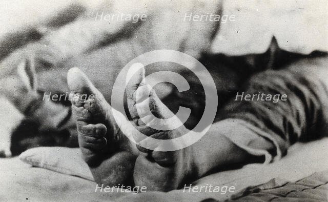 Feet of a Chinese woman, showing the effect of foot-binding, between 1900 and 1999. Creator: Unknown.