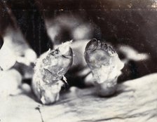 Friern Hospital, London: a child's feet viewed from below, 1890/1910. Creator: Unknown.