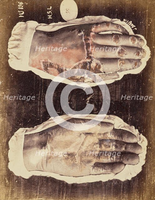 Psoriasis scarlatiniforme, 1871. Creator: Arthur de Montmeja.