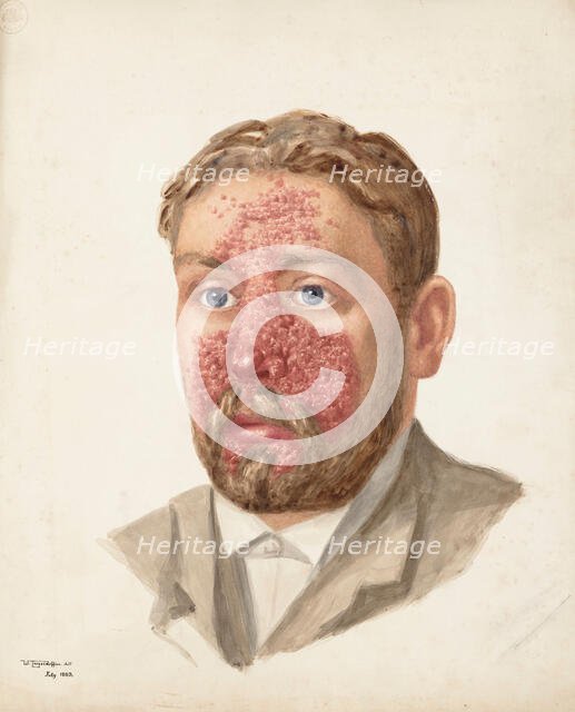 The head of a man with skin disease, July 1889. Creator: W Toogood Hill.