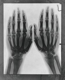 Two hands, viewed through x-ray, 1896.