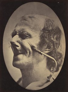 Figure 6: The grimace produced is similar to a tic of the face , 1854-56, printed 1862. Creators: Duchenne de Boulogne, Adrien Alban Tournachon.