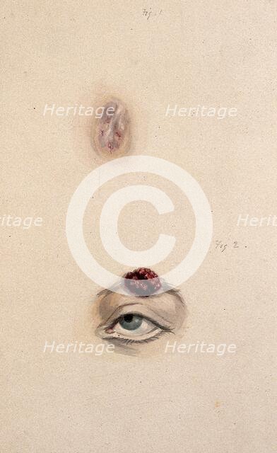 A section of a child's diseased forehead (detail); and a child's diseased eyebrow..., 1829. Creator: Unknown.