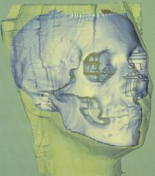 Stages in facial reconstruction of the bathrocranic skull. Artist: Unknown
