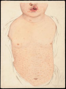 A boy with a congenital deformity of the mouth and a rash on the trunk, Feb 16th 1901. Creator: Mabel Green.