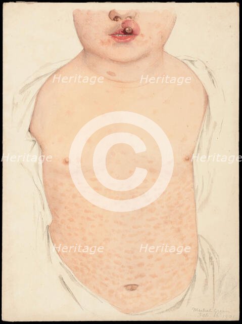 A boy with a congenital deformity of the mouth and a rash on the trunk, Feb 16th 1901. Creator: Mabel Green.