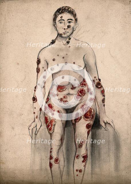 A woman suffering from open sores and abcesses on her face and entire body, 1867. Creator: Christopher D'Alton.