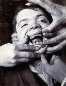 Friern Hospital, London: a boy with rotten teeth, 1890/1910. Creator: Unknown.