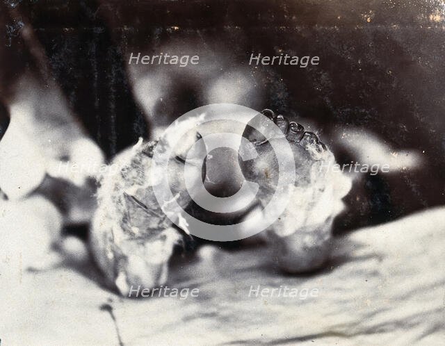 Friern Hospital, London: a child's feet viewed from below, 1890/1910. Creator: Unknown.