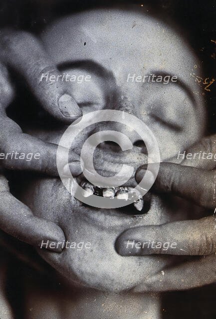 Friern Hospital, London: a young child with rotten teeth, 1890/1910. Creator: Unknown.