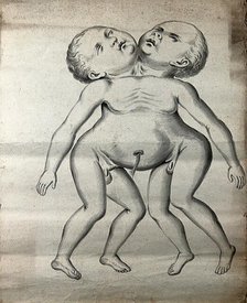 Male conjoined twins joined at the neck and chest; anterior view, 1900. Creator: Unknown.