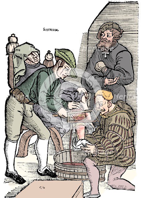 Amputation of a leg without anaesthetic, 1593. Artist: Unknown.