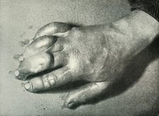 'Dr. Atkinson's Frost-Bitten Hand', 5 July 1911, (1913). Artist: Herbert Ponting.
