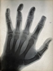 The bones of a hand, with the tip of the index finger missing, viewed through x-ray, 1896.