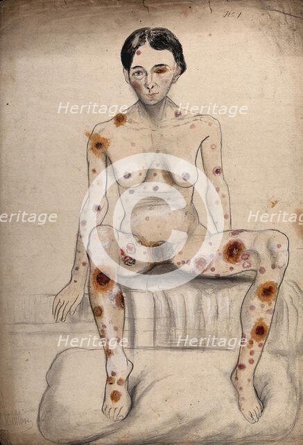 A seated woman displaying areas of diseased tissue on her entire body, face, genitals and eye, 1858. Creator: Christopher D'Alton.
