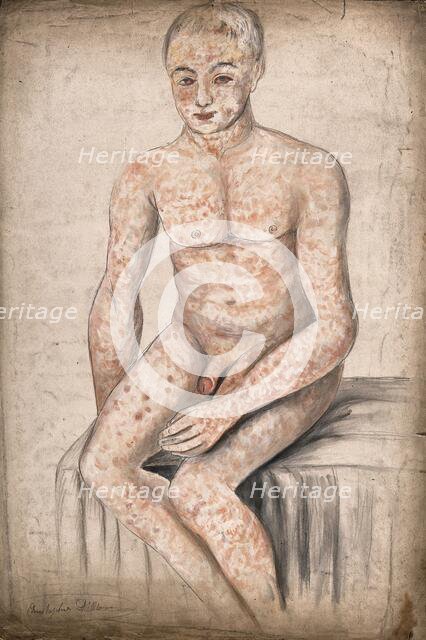 A seated man suffering from a mottled rash of sores, which covers his entire body and face, 1858. Creator: Christopher D'Alton.