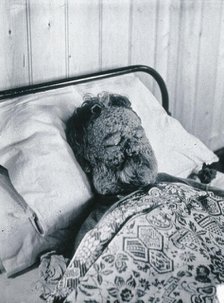 Gloucester smallpox epidemic, 1896: George Steel as a smallpox patient, 1896. Creator: HCF of Gloucester.