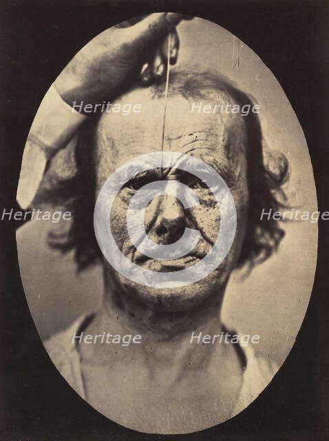 Figure 17: On the right, electrization of m. procerus: severity, aggressi..., 1854-56, printed 1862. Creators: Duchenne de Boulogne, Adrien Alban Tournachon.