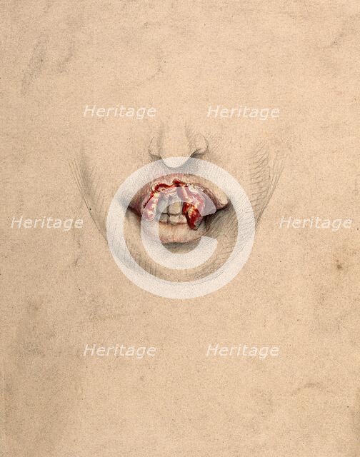 Severely diseased tissue on the upper lip of a woman suffering from tertiary syphilis, 1869. Creator: Christopher D'Alton.
