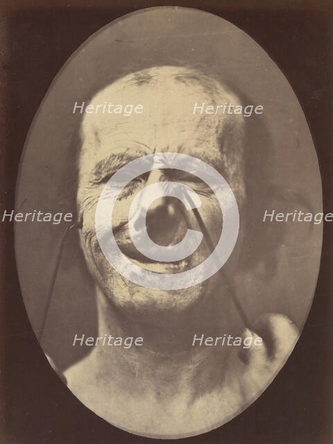 Figure 53: Whimpering and false laughter, 1854-56, printed 1862. Creators: Duchenne de Boulogne, Adrien Alban Tournachon.
