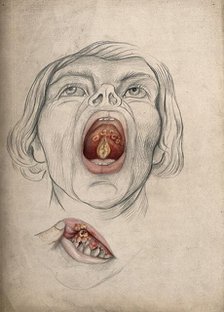 The face of a man, with mouth open wide, displaying diseased areas of..., between 1800 and 1899. Creator: Christopher D'Alton.