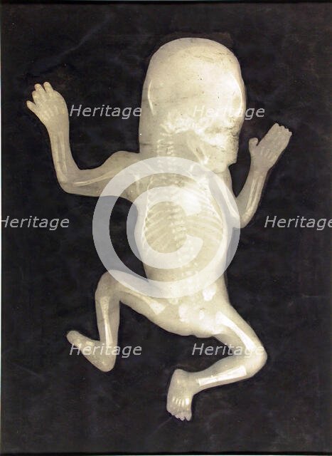 Degree of Ossification of a Five-Month-Old Fetus (Degré d'ossification d'un Foetus de cinq mois), 18 Creator: Unknown.