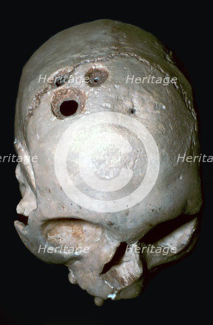 Trepanned Skull. Artist: Unknown