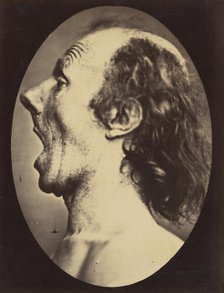 Figure 55: Astonishment badly rendered by the subject: a ridiculous and i..., 1854-56, printed 1862. Creators: Duchenne de Boulogne, Adrien Alban Tournachon.