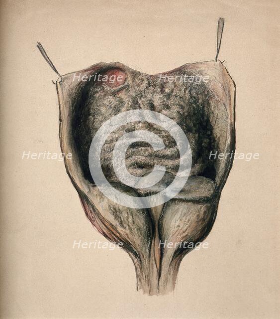 Dissection of diseased intestines, (1851?). Creator: Unknown.