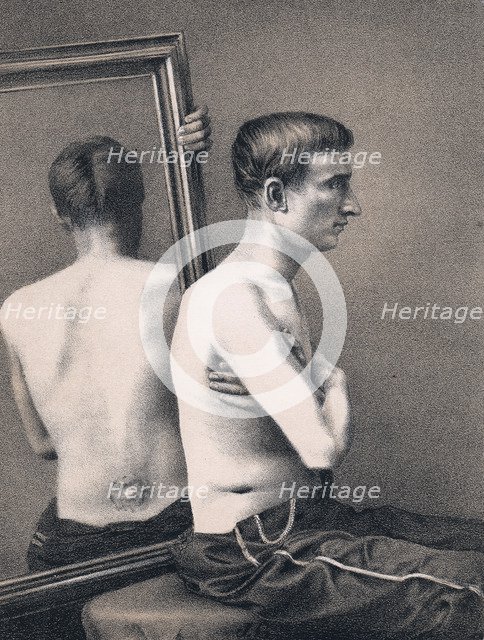 Recovering casualty of a bullet wound to the abdomen, American Civil War, 1865. Artist: Unknown