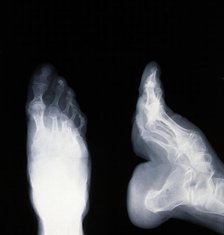A deformed foot: X-ray, 20th century. Creator: Unknown.