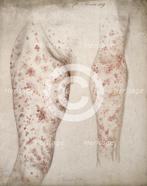 Sores and diseased skin on the leg and arm of a woman, 1856. Creator: Christopher D'Alton.