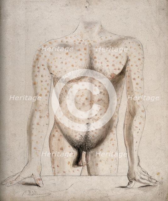 The torso, arms and upper thighs of a man suffering from a rash of sores, (1853?). Creator: Christopher D'Alton.