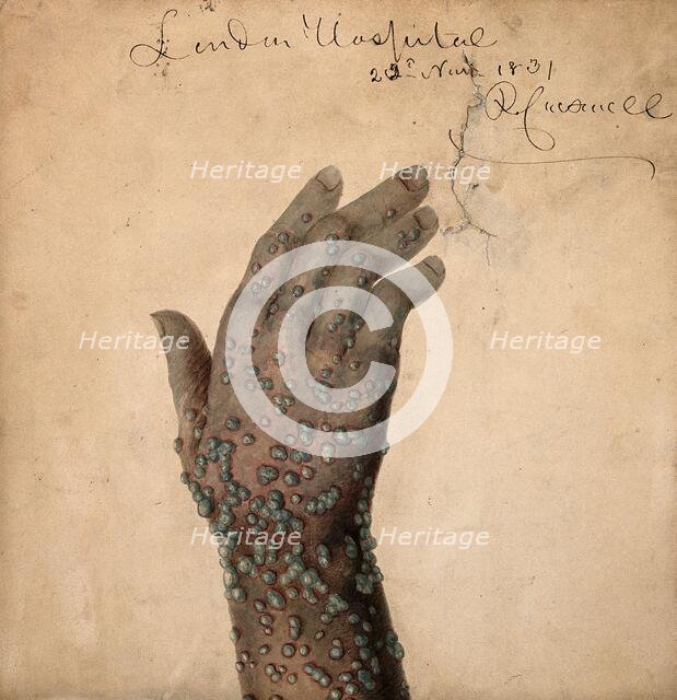 Rash of pustules on the hand of a patient, probably suffering from smallpox, 1831. Creator: Robert Carswell.