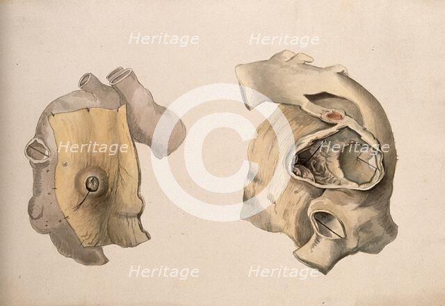 Two diseased parts of the body. Creator: Unknown.