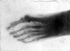 The bones of a pantomime artist's foot, viewed through x-ray; revealing a needle by one of..., 1896. Creator: Unknown.