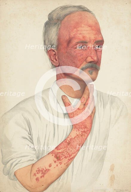 A man with disease designated as Lupus erythematosus, 1902. Creator: Mabel Green.