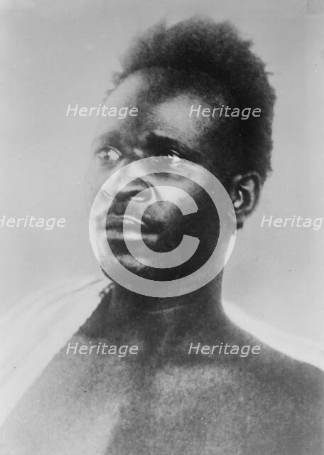 Wounded "French" prisoner of Germans, between c1910 and c1915. Creator: Bain News Service.