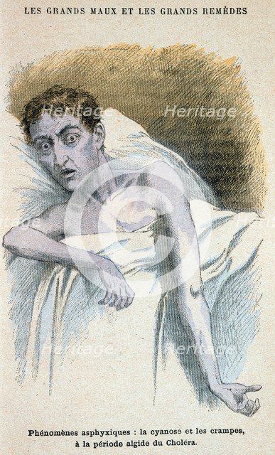Cholera patient. Artist: Unknown
