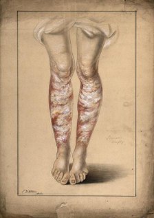 Diseased skin on the legs of a man suffering from psoriasis, 1873. Creator: Christopher D'Alton.