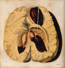 A diseased brain, 1800-1850. Creator: Richard Bright.