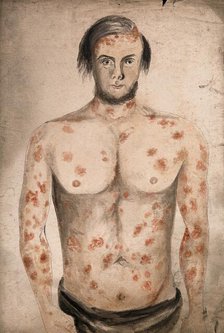 The face, arms and torso of a man suffering from diseased skin and abcesses (?), between 1800 & 1899 Creator: Christopher D'Alton.