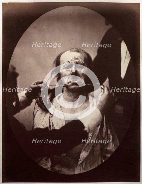 Figure 45: Contraction électrique forte des triangulaires des lèvres et des sourciliers:..., c. 1856 Creator: Guillaume-Benjamin-Amand Duchenne (de Boulogne) (French, 1806-1875); Adrien Tournachon (French, 1825-1903).