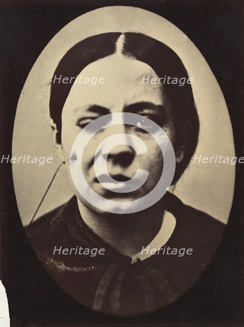 Figure 50: Affected weeping and face in repose, 1854-56, printed 1862. Creators: Duchenne de Boulogne, Adrien Alban Tournachon.