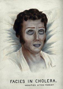 A cholera victim with a typical facial appearance, 1920-1950. Creator: Unknown.