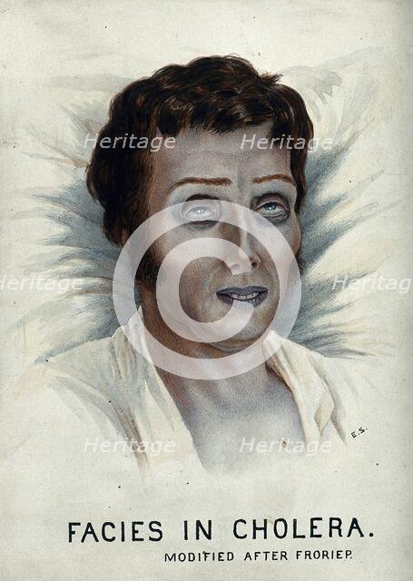 A cholera victim with a typical facial appearance, 1920-1950. Creator: Unknown.
