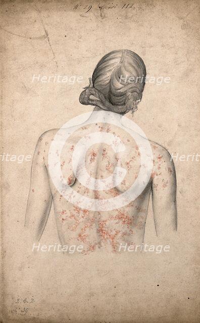 Back of a woman suffering from a rash of sores, 1855. Creator: Christopher D'Alton.