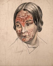 Head of a woman with a severe disease affecting her face, (18)58. Creator: Christopher D'Alton.