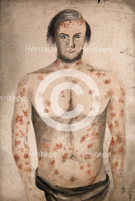 The face, arms and torso of a man suffering from diseased skin and abcesses (?), between 1800 & 1899 Creator: Christopher D'Alton.