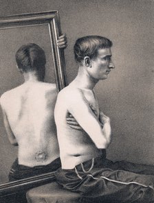 Recovering casualty of a bullet wound to the abdomen, American Civil War, 1865. Artist: Unknown